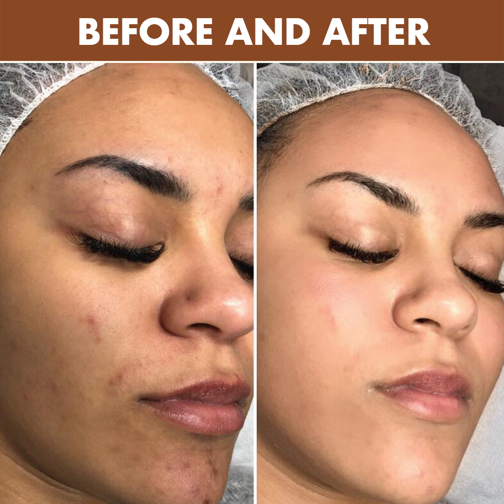 Private Label Caramel Skincare Products Black Skin Brightening Glow Acne Treatment Face Toner Serum Korean Skin Care Set