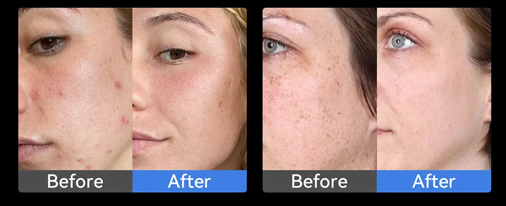Professional Medical Grade Microneedling Pen Biopen EMS Microneedlng Pen Skincare Device EMS 5 Speeds LED Light Therapy Device for Sales