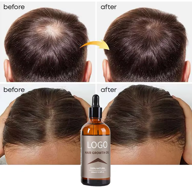 OEM High Quality Fast Hair Growth Oil Private Label Best Rosemary Natural Smoothing Oil Vitamins Hair Growth Care Treatment Oil