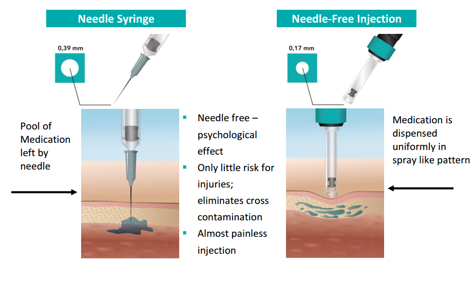 Dental Non- Pain Oral Local Anesthesia Syringe No Needle No Pain