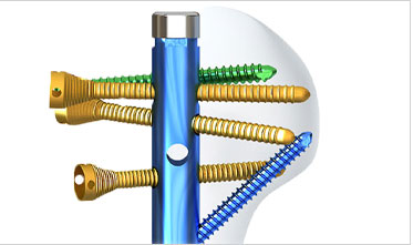 Proximal fixation