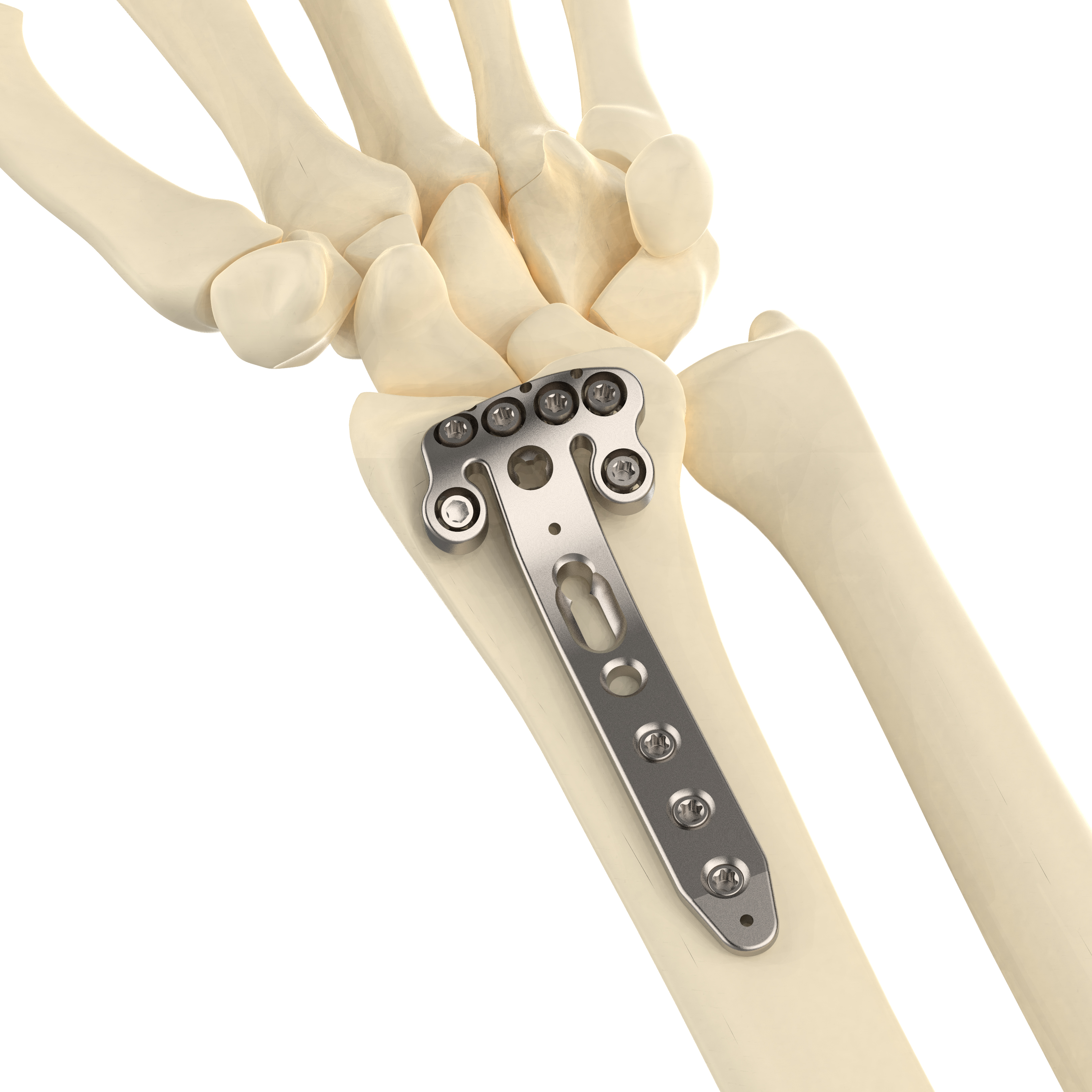 CANWELL Titanium Distal Radius Locking Plate (Fibula) Extra Long Two Column Variable Volar 3-Hole 2.4mm Class III CE Implant