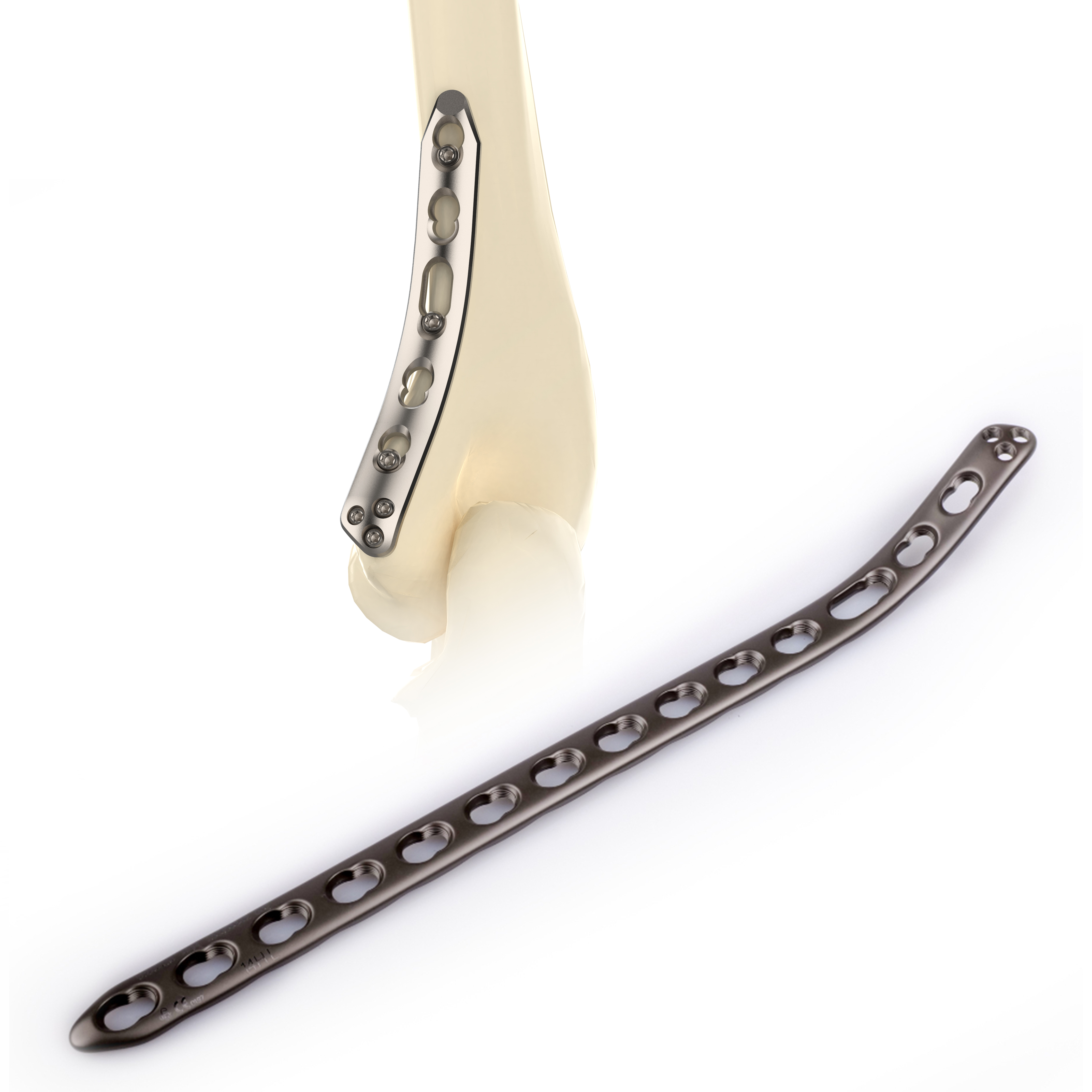 CANWELL Distal Medial Humeral Titanium Locking Plate Shaft Broken Bone Orthopedic Implants Trauma Fracture Surgery CE ISO OEM