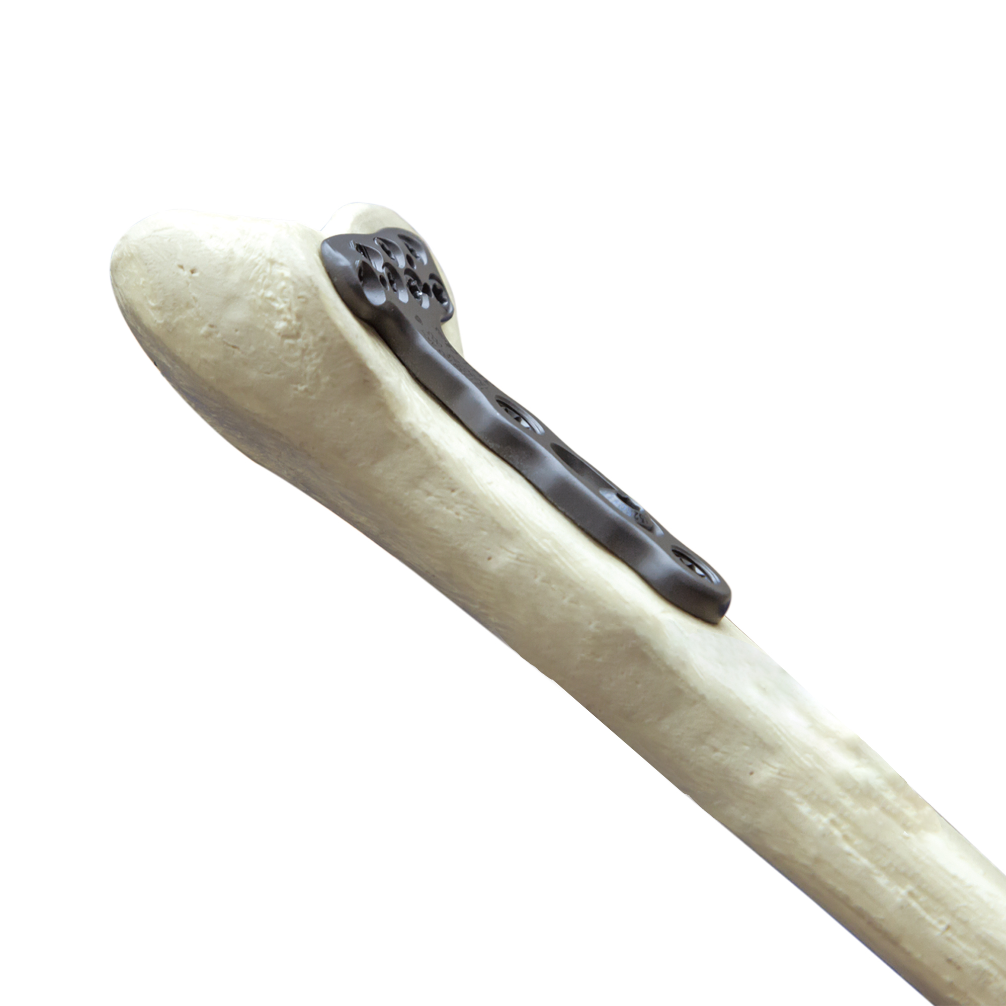 CANWELL Distal Radius Volar Locking Plates Titanium Orthopedic Surgical Trauma Implants Anatomic CE/ISO Certified AO Standard