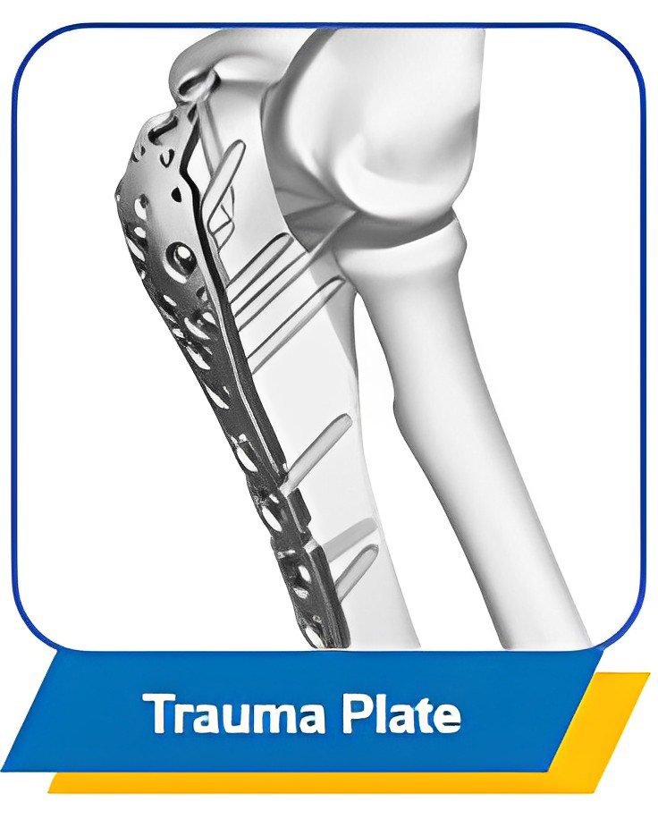 Geasure Titanium Proximal Lateral Tibia Locking Plate Orthopedic Surgery Implants & Interventional Materials for Hospital Use