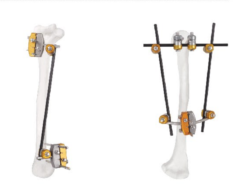 Orthopedic External Fixator Orthopedic Surgery Combined  External Fixator Rod and Pin Clamp Connection