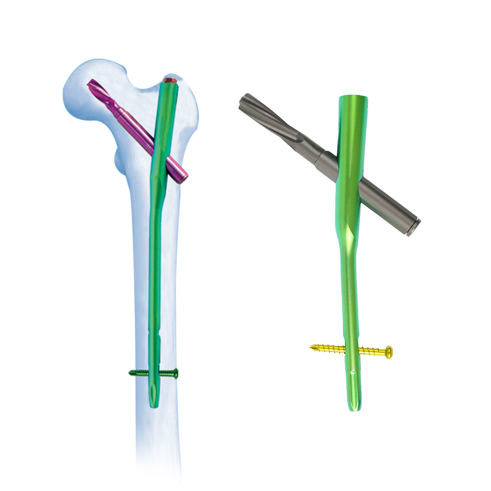 High-Quality Orthopedic Implant: Femoral PFNA Intramedullary Nail