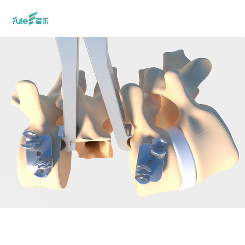 Latest Spine Surgery Titanium Implant FATA Mesh Combination Interventional Materials Product