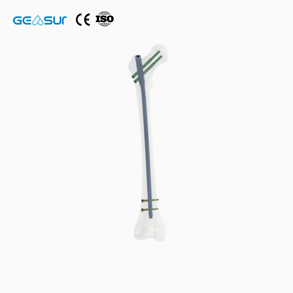 Geasure CE ISO Certified Advanced Trochanteric Femoral Intramedullary Nail Class III Orthopedic Implant 1 Year Warranty Jiangsu