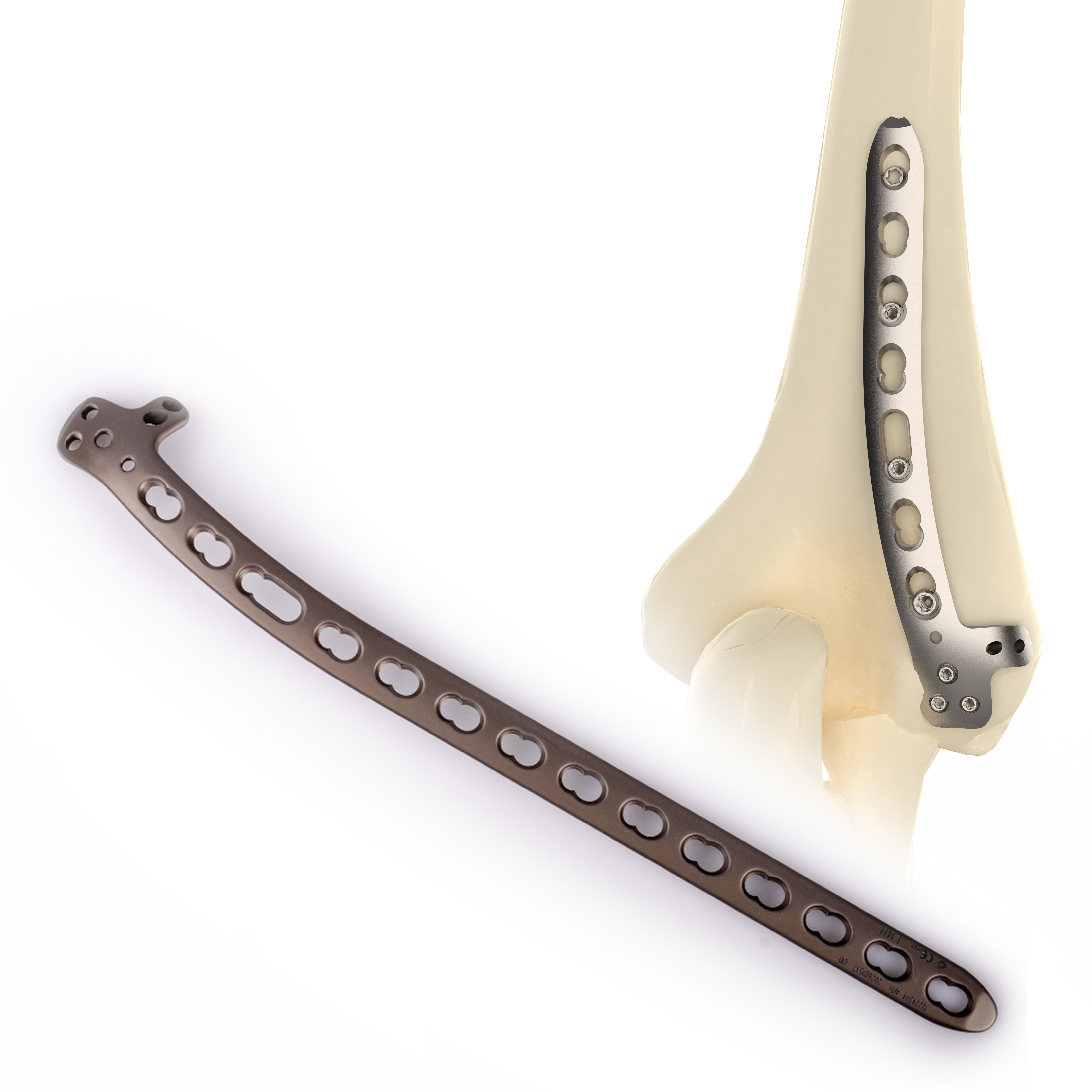CANWELL Humeral Locking Plate 02 Titanium Distal Lateral Dorsal Anatomical Bone Orthopedic Trauma Fracture Surgery CE OEM Class