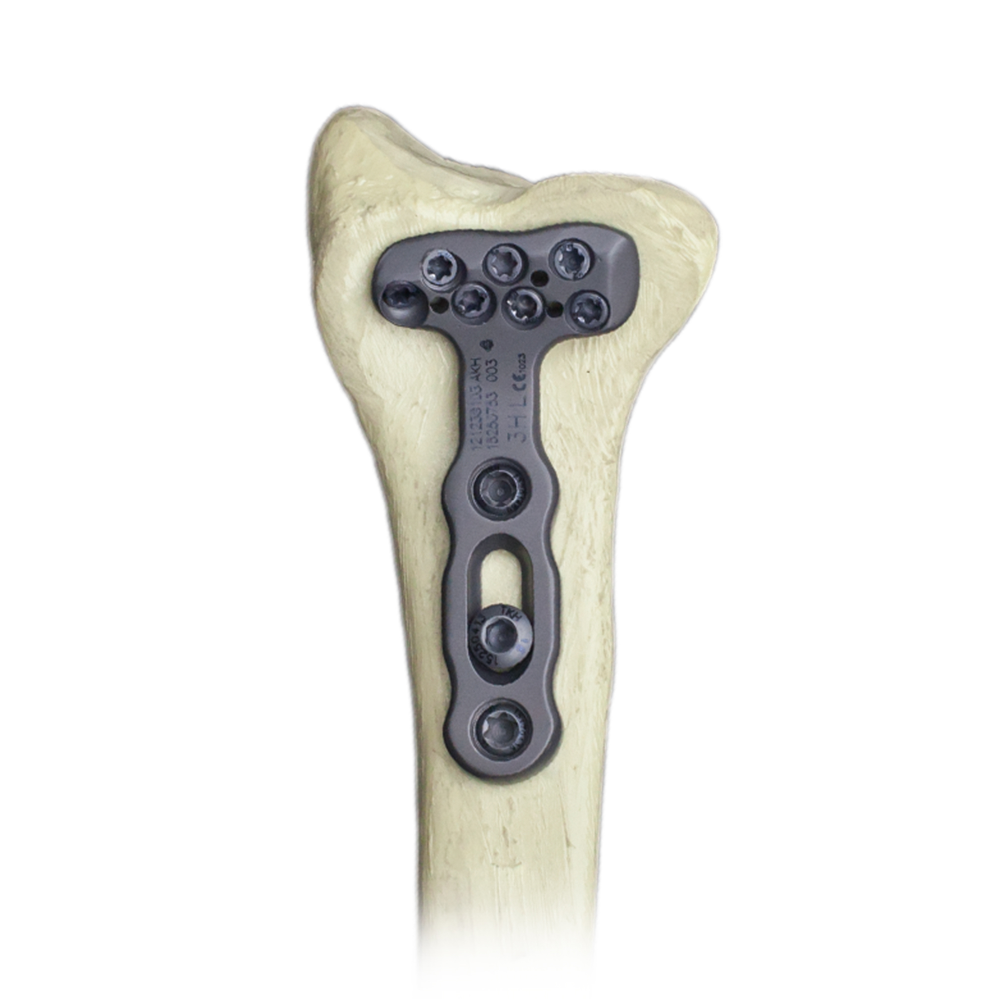 CANWELL Titanium Orthopedic Trauma Implants Variable Angle Locking Plate System for Volar Distal Radius Fracture Fixation AO