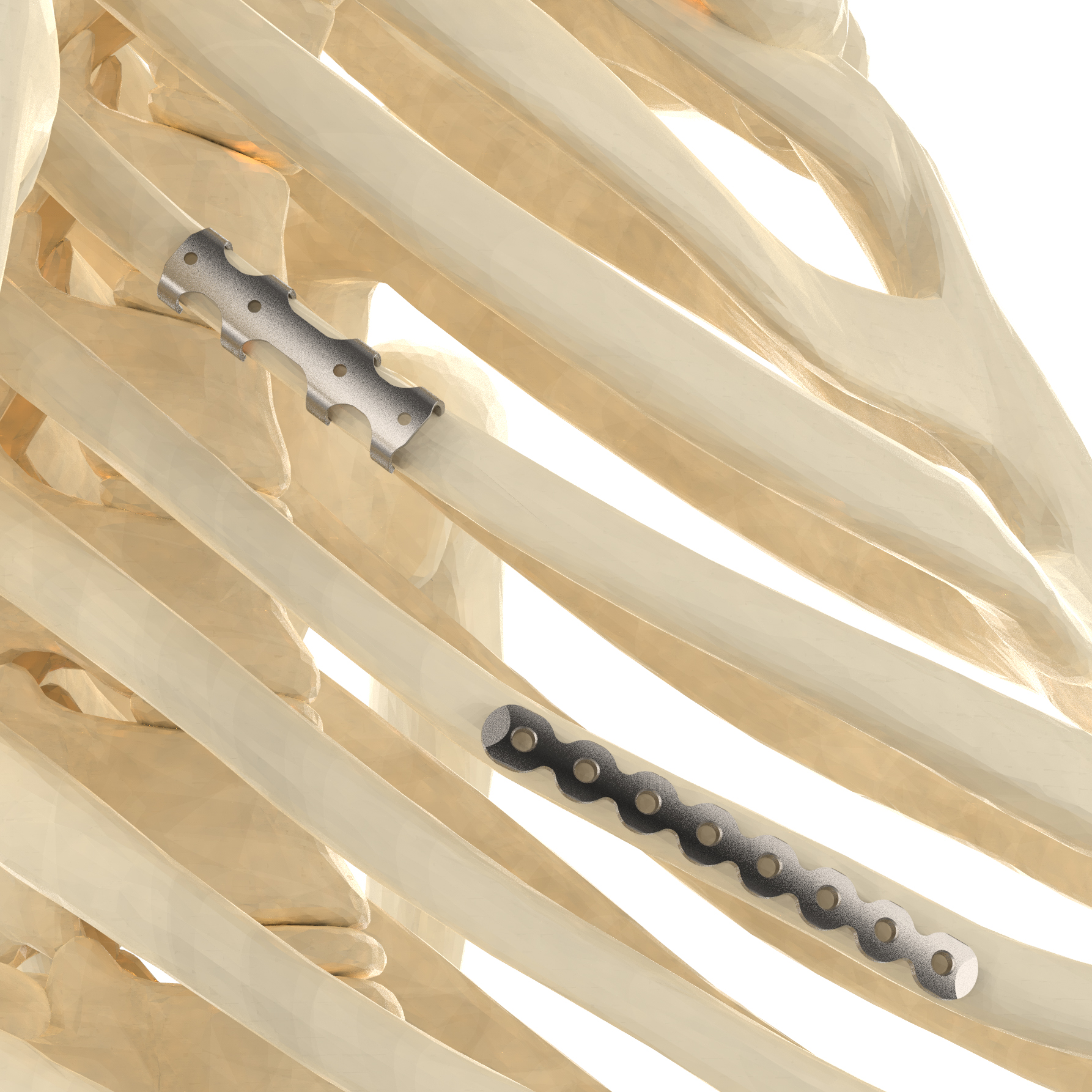 CANWELL Titanium Rib Locking Plate Bone Fixation Orthopedic Trauma Implant for Fracture Surgery CE ISO