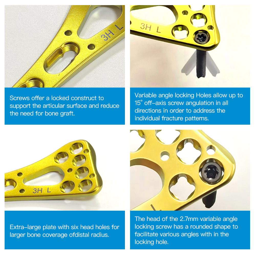Geasure  Distal Radius Locking Plate Variable Angle Two-Column Volar Distal Radius Plate