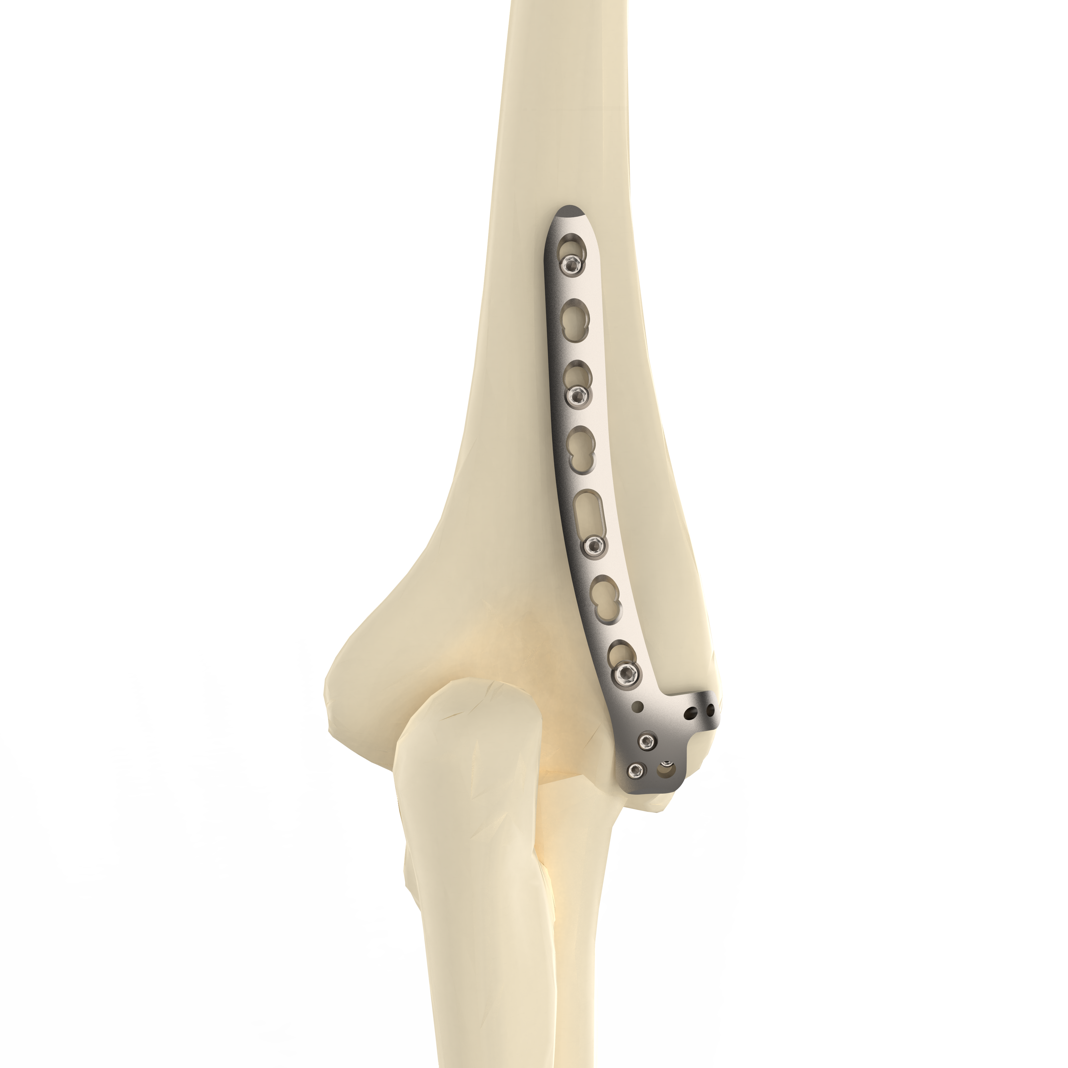 CANWELL Humeral Locking Plate 02 Titanium Distal Lateral Dorsal Anatomical Bone Orthopedic Trauma Fracture Surgery CE OEM Class