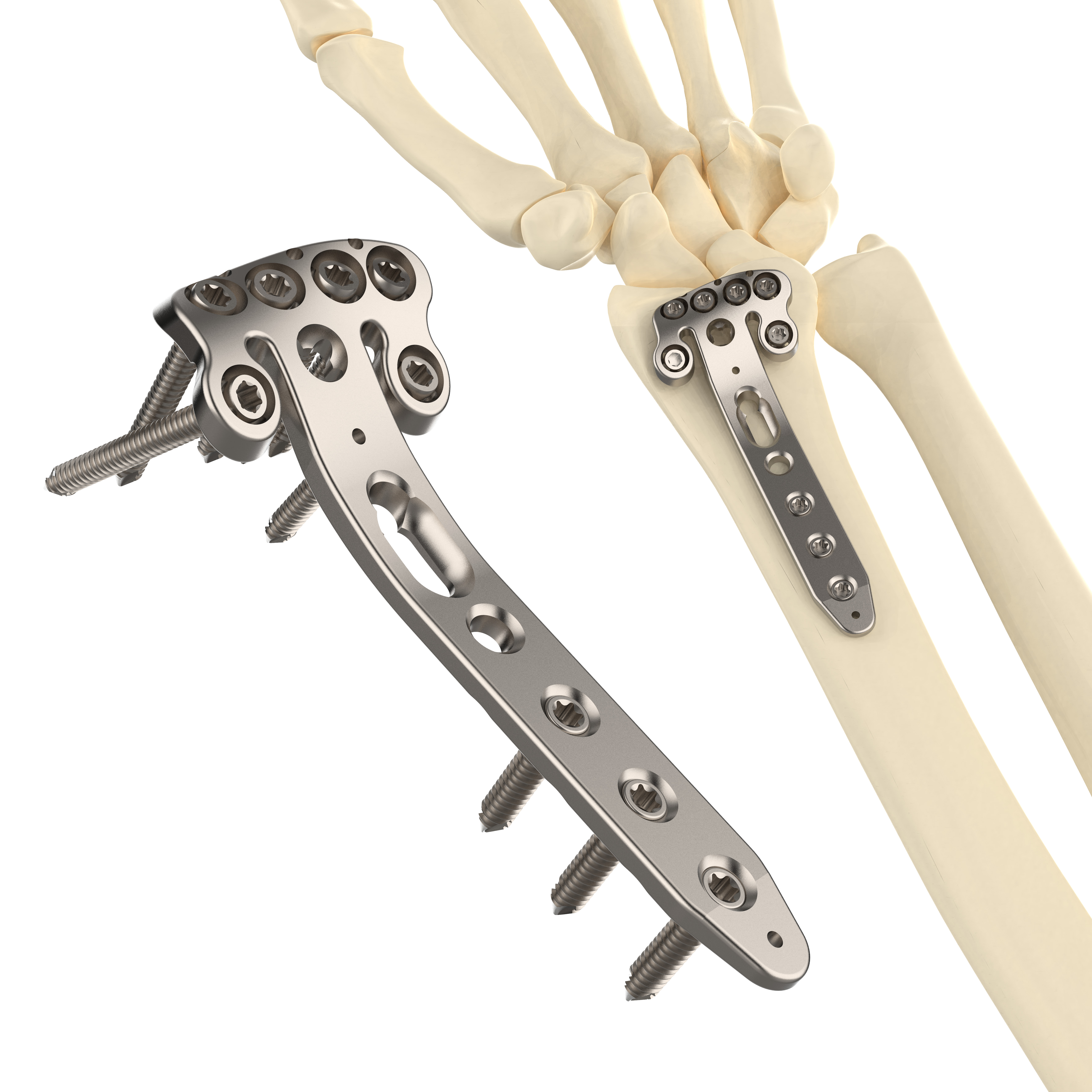 CANWELL Titanium Distal Radius Locking Plate (Fibula) Extra Long Two Column Variable Volar 3-Hole 2.4mm Class III CE Implant