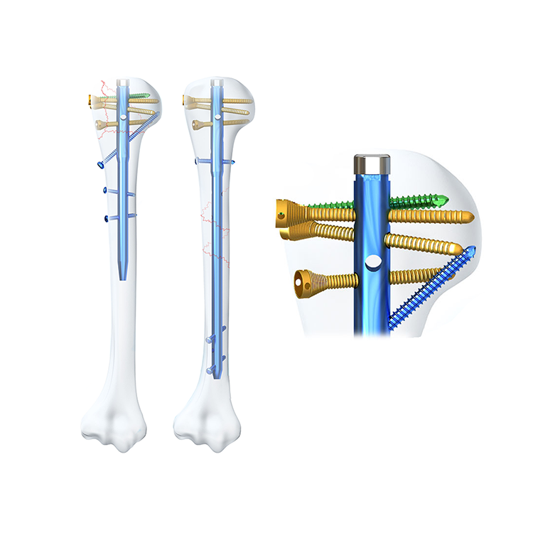 Geasure Orthopedic Implant Titanium Alloy CE Certified Class III Multi Dimensional Humeral Intramedullary Humerus Interlocking