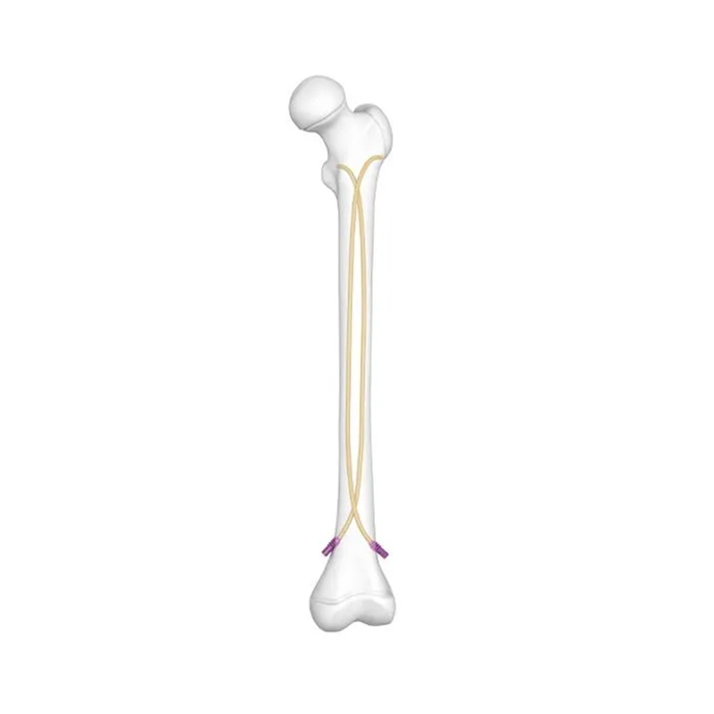 Elastic Nail