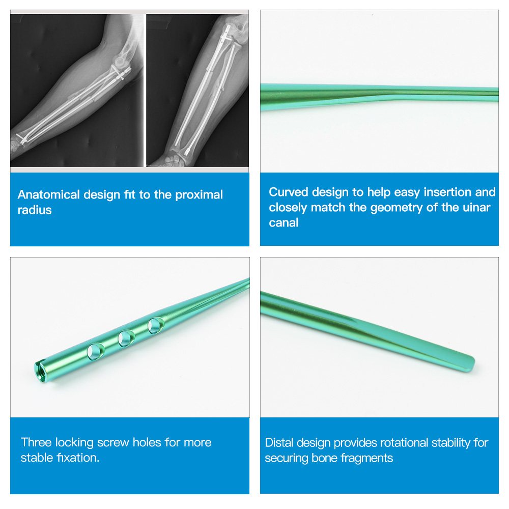 Radius & Ulna Intramedullary Nail Titanium Alloy Forearm Shaft Fracture Fixation System CE ISO Geasure Class III