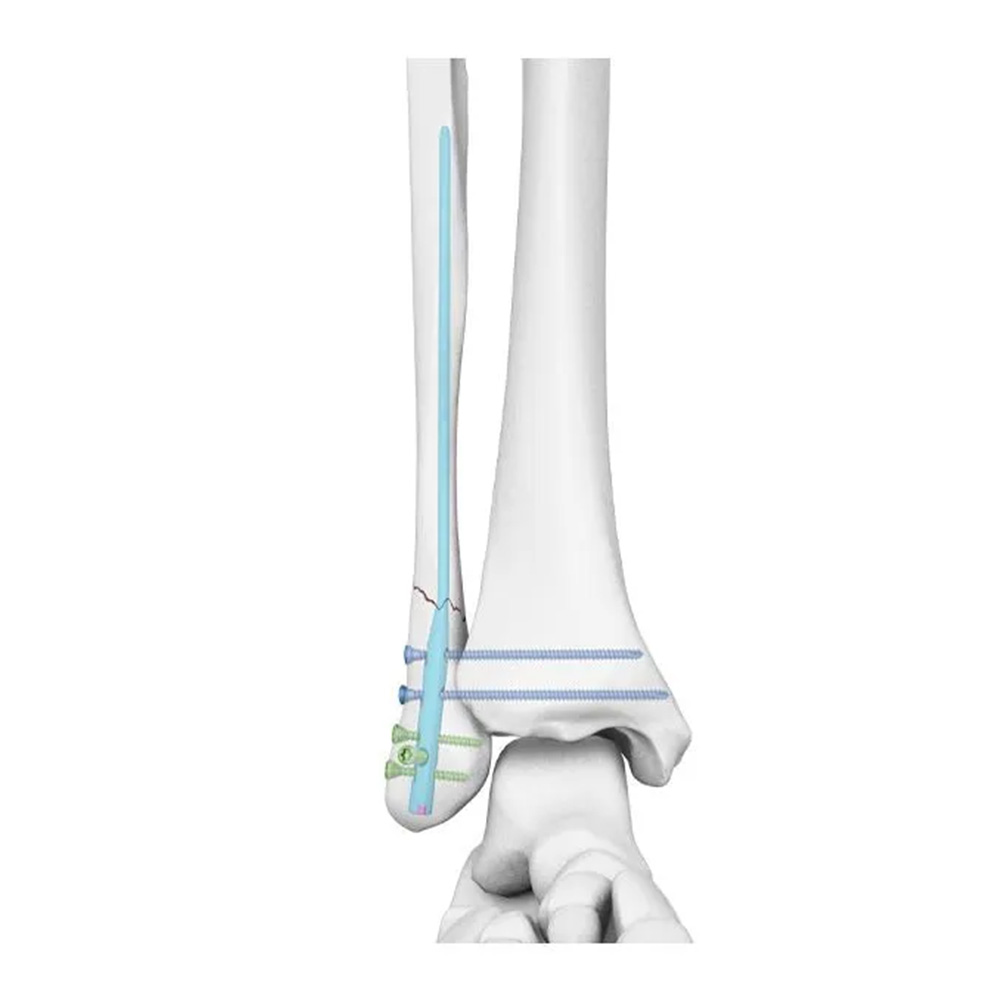 Fibula Nail