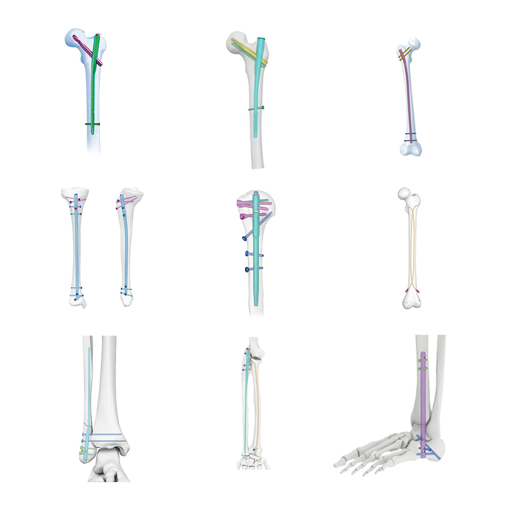 Intertan Intramedullary Nail Titanium Alloy CE Certified Class III Minimally Invasive Surgery Instrument Set Precision Aiming