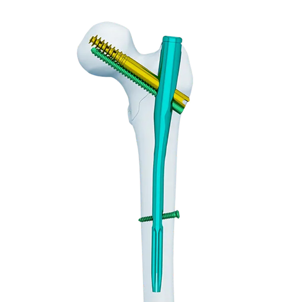 Intertan Nail
