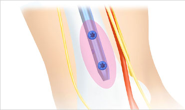 Distal fixation