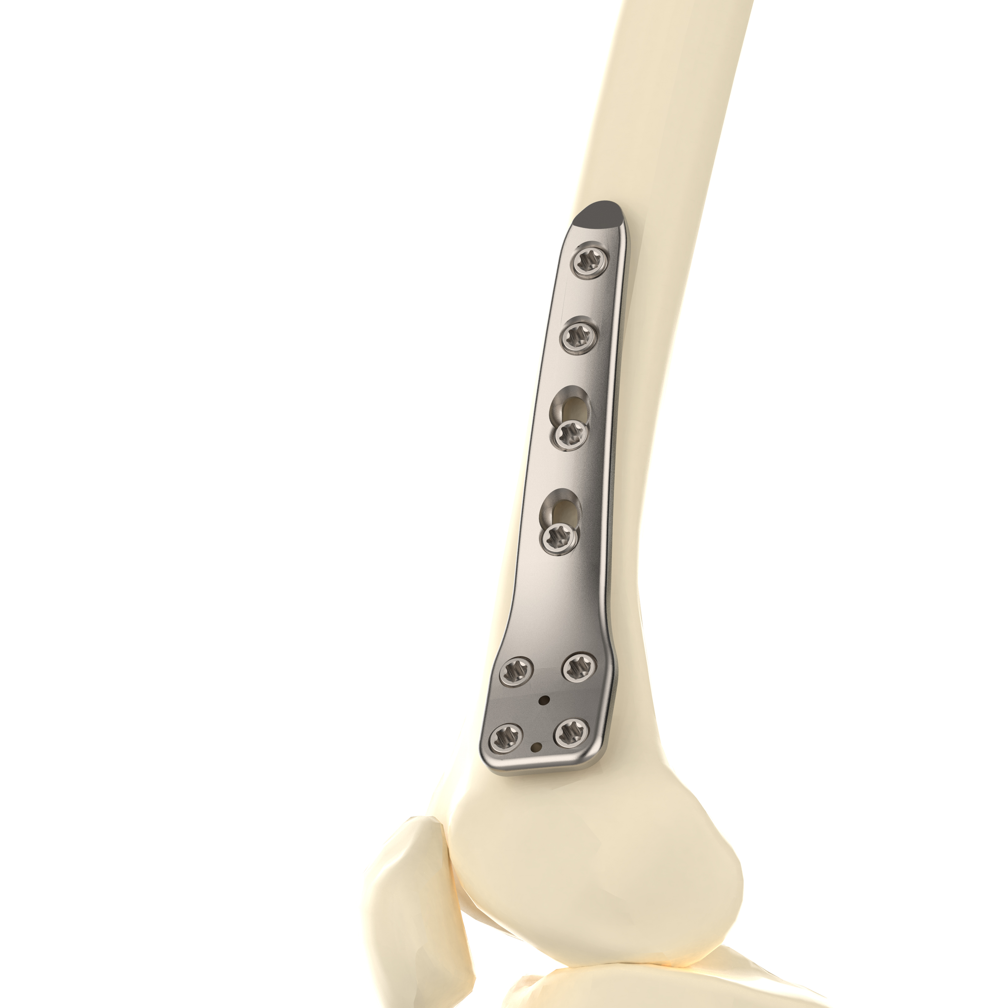 CANWELL Distal Medial Femoral Osteotomy Titanium Locking Plate Orthopedic Implant Trauma Bone Fracture Surgery CE OEM Class III
