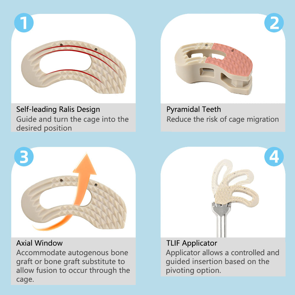 Geasure Medical-Grade PEEK Lumbar TLIF Cage for Spinal Surgery