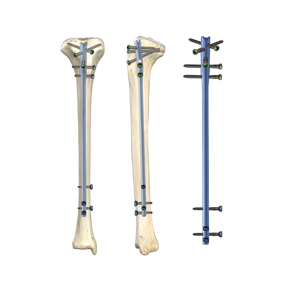 Tibia Intramedullary Nail Reamed and Unreamed Titanium Alloy CE Certified Tibial Nailing System for Adult Trauma