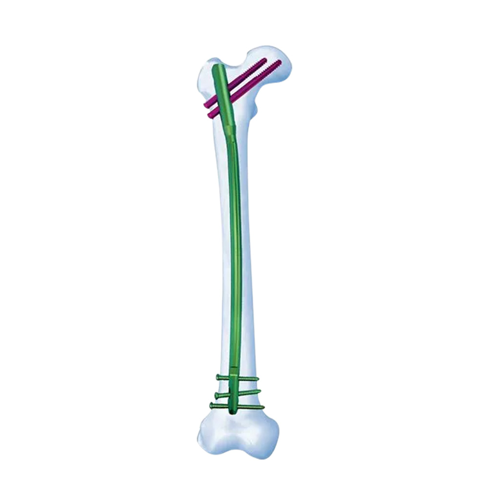 Femoral Nail