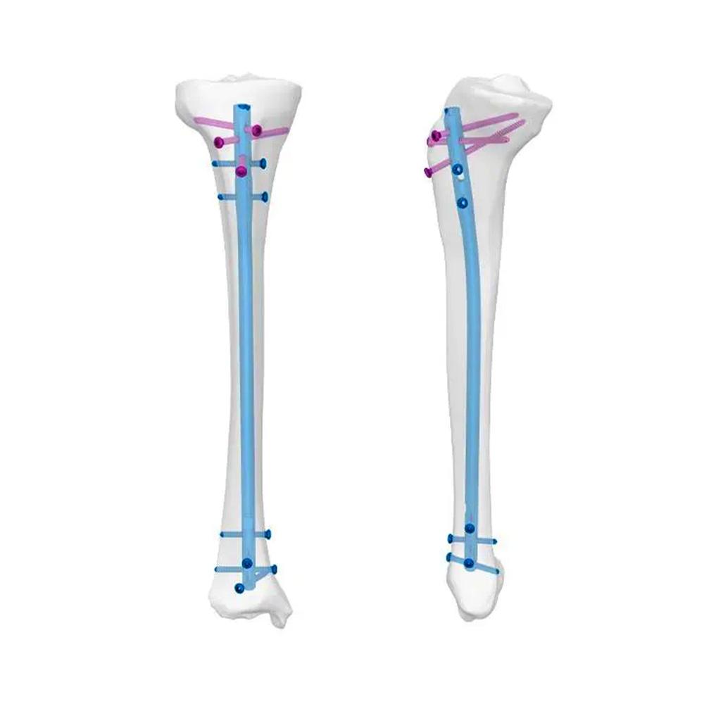 Geasure Class III Tibia Intramedullary Nail Titanium Alloy Tibial Shaft Fracture Fixation System CE Certified