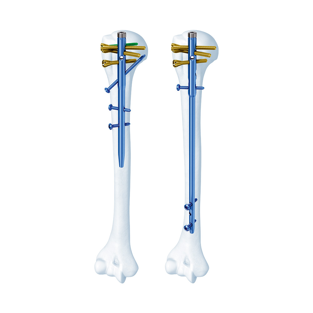 Humerus Nail
