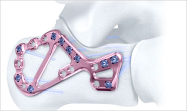 Calcaneus plate