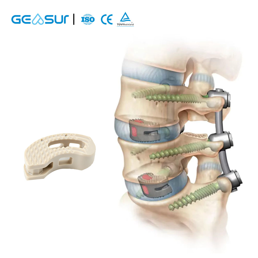 Geasure Medical-Grade PEEK Lumbar TLIF Cage for Spinal Surgery