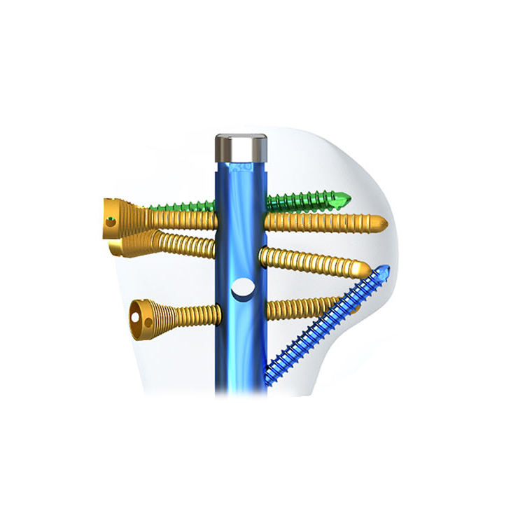 Geasure Trauma Orthopedic Implants Interlocking Titanium Alloy Multi-Lock Humeral Intramedullary Nail CE ISO Certified Class III