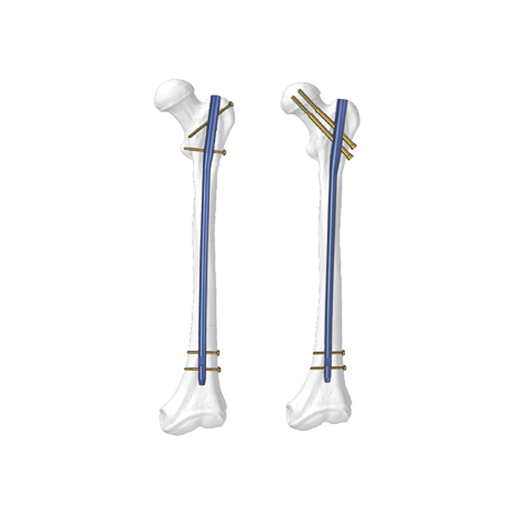 Titanium Alloy Femoral Intramedullary Nail Proximal Femoral Nailing System for Intertrochanteric Fractures