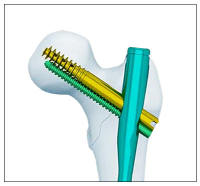 Lateral flat cut design