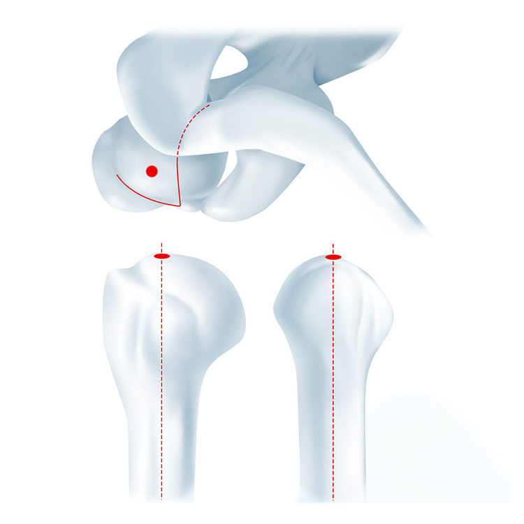 Multiloc Interlocking Intramedullary Humeral Nail Titanium Alloy Orthopedic Implant for Hospital Trauma Applications