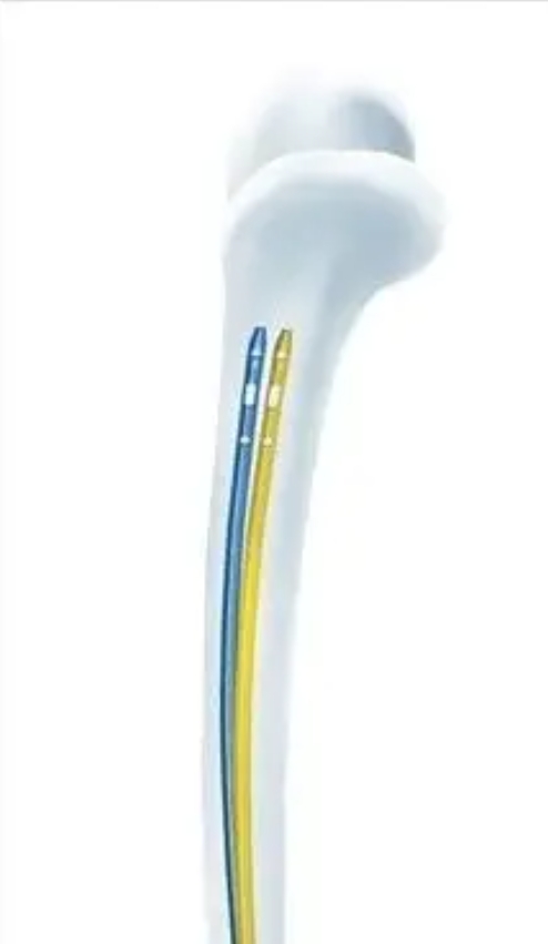 Geasure High Quality Ortopedia Intramedullary Titanium Femoral Pfna Nails  for Orthopedic Surgery