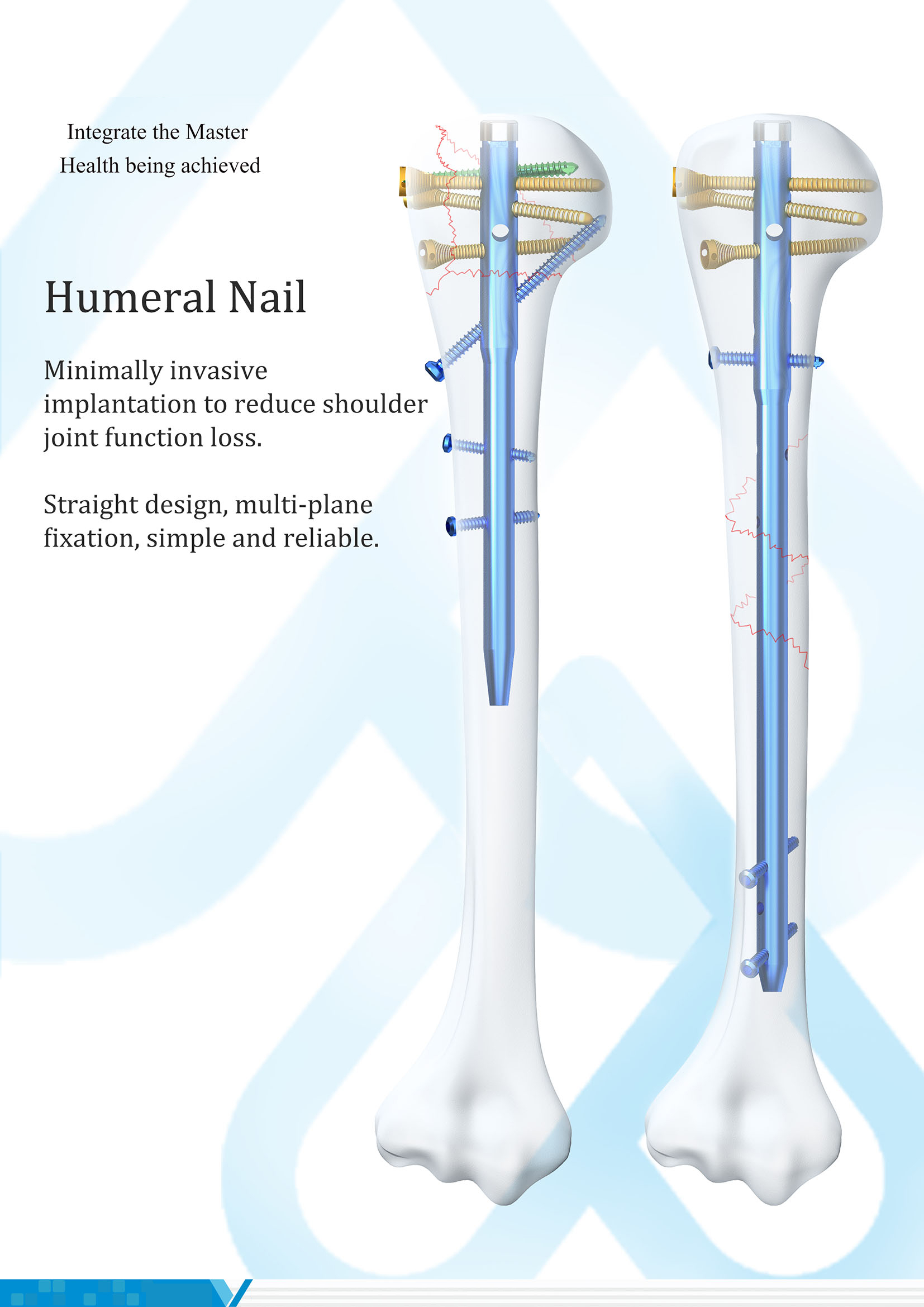 Multiloc Interlocking Intramedullary Humeral Nail Titanium Alloy Orthopedic Implant for Hospital Trauma Applications