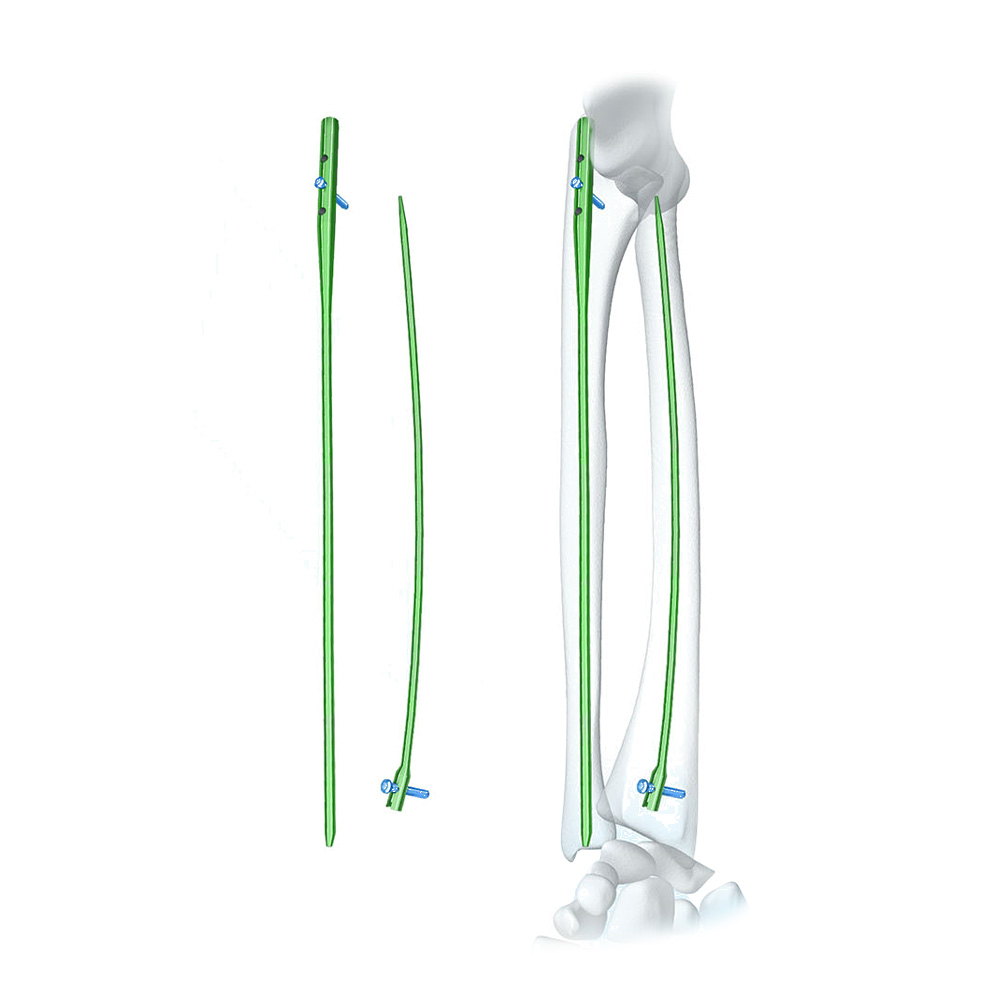 Radius & Ulna Intramedullary Nail Titanium Alloy Forearm Shaft Fracture Fixation System CE ISO Geasure Class III