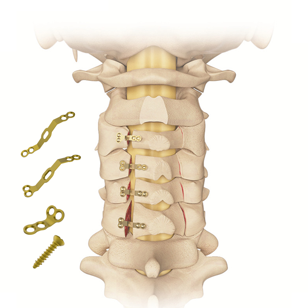 CANWELL Laminoplasty Fixation System Titanium Laminoplasty Plate and Screws Spine Surgery Posterior Cervical Laminoplasty System