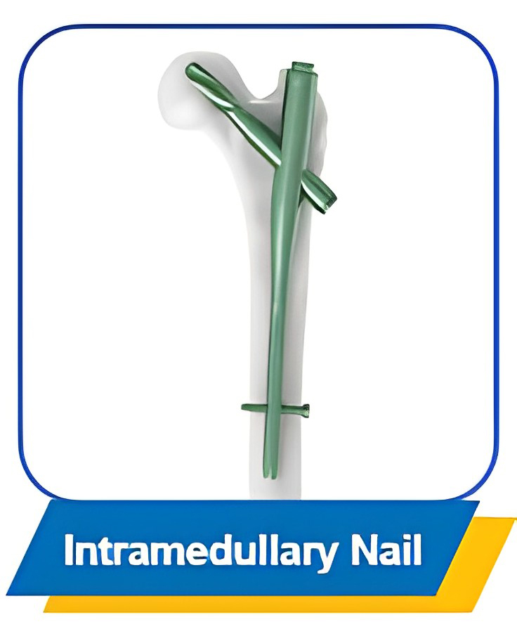 Competitive Price Biocomposite Suture Anchor Absorbable Medical Knotless Suture of High Quality