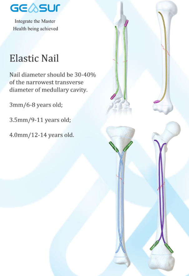 Elastic Nail view 2
