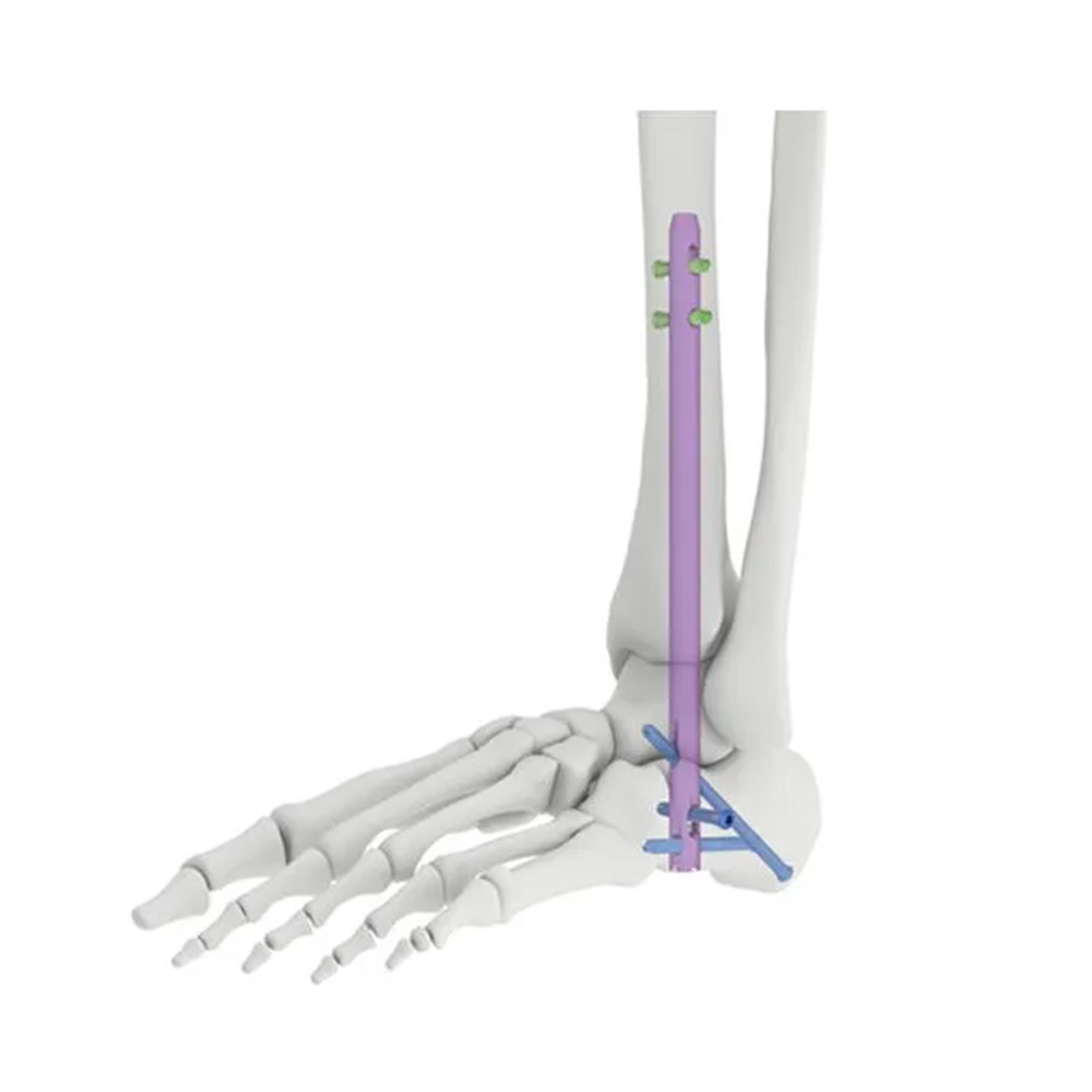 Ankle Arthrodesis Nail