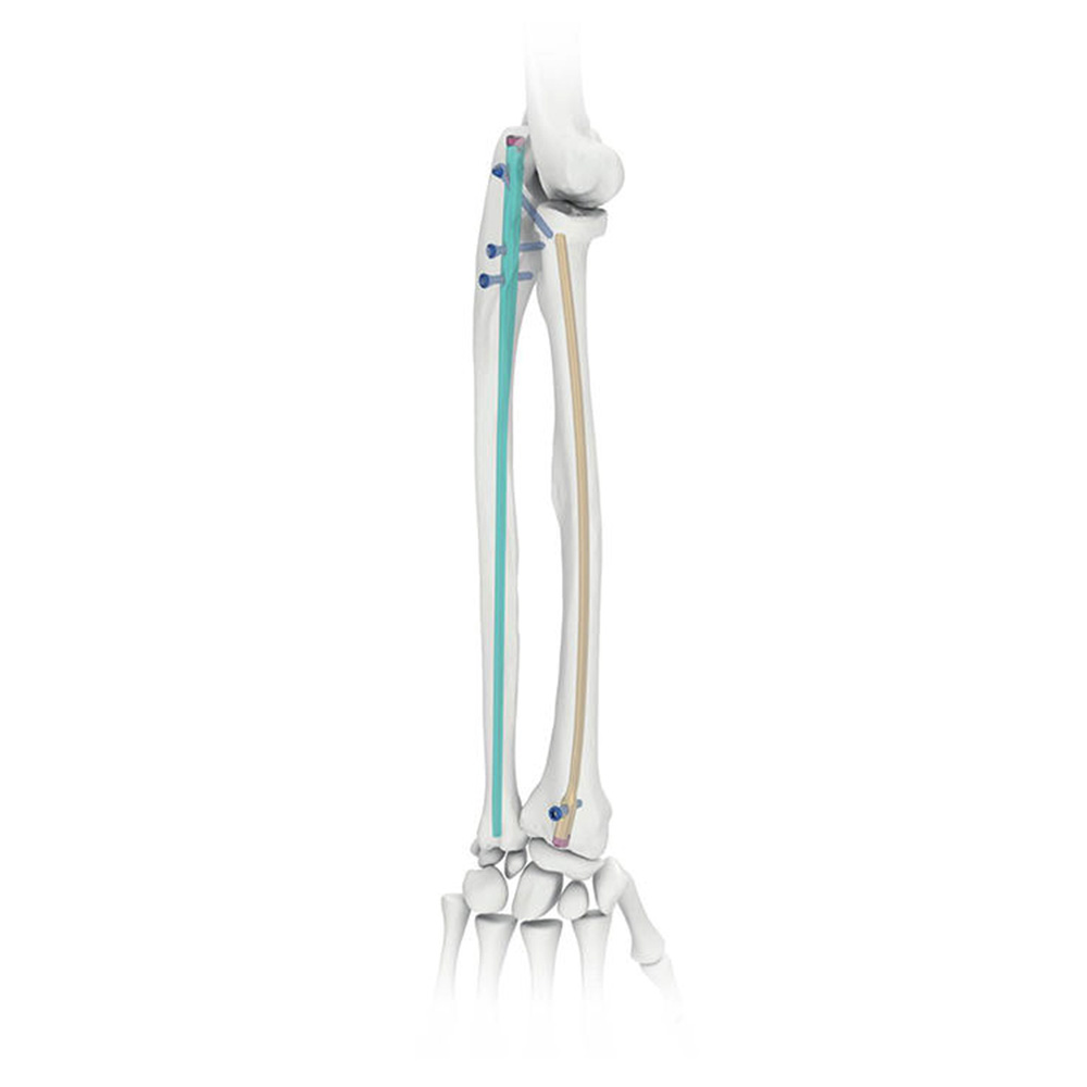 Radius & Ulna Intramedullary Nail Proximal Femoral Nailing System for Radius & Ulna Fractures Titanium Alloy CE Certified