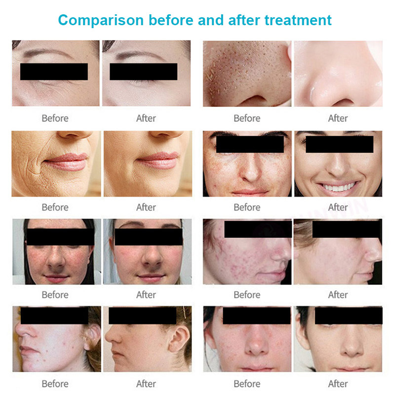 Factory Price Facial Care Wrinkles Removal Skin Rejuvenation Oxygen Spray Vacuum Blackhead Remover