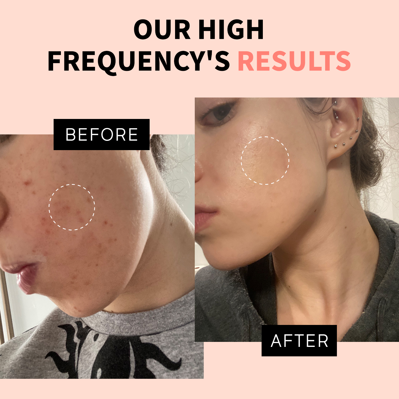 Portable Multifunction USB Facial Machine Home Use High Frequency Neon Argon Electrotherapy Acne Treatment Head Care Wand