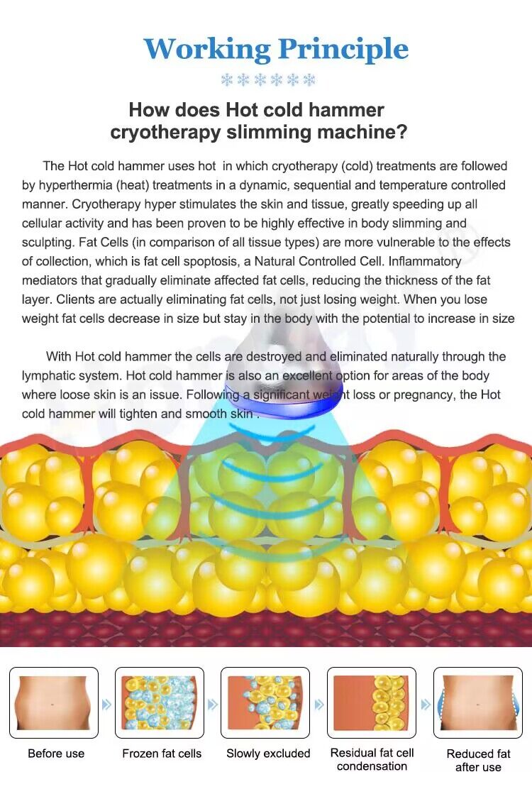 Cryotherapy details