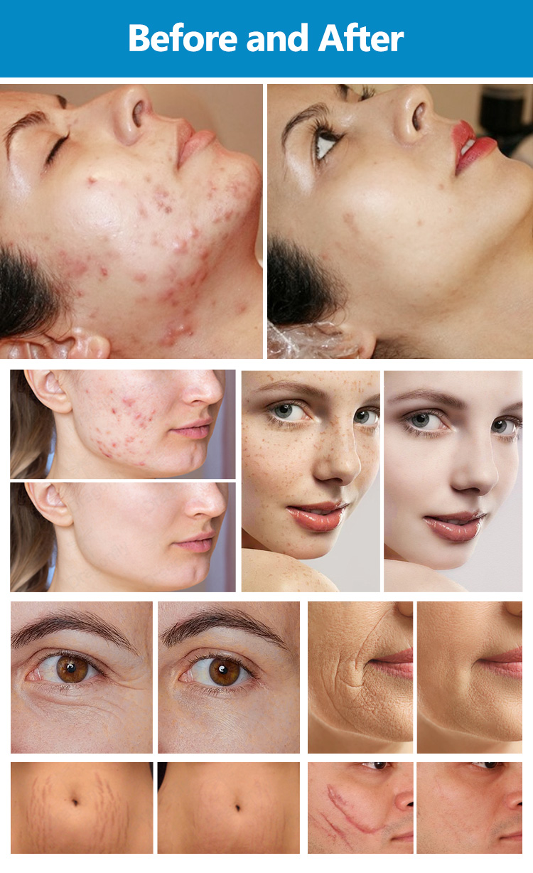 CO2 Fractional Laser Machine Treatment Results 23
